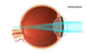 Refractive Errors